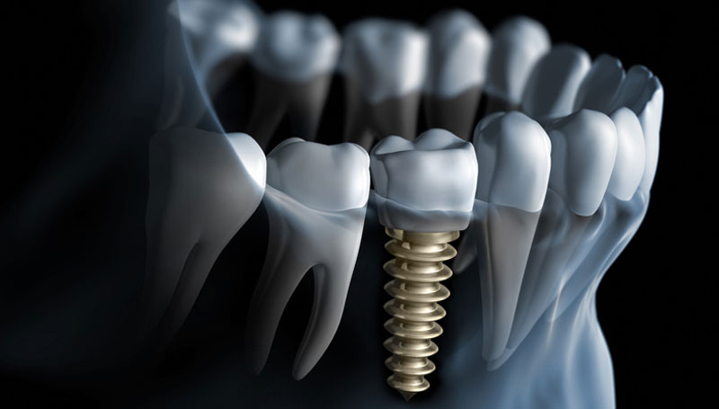 Dental implants