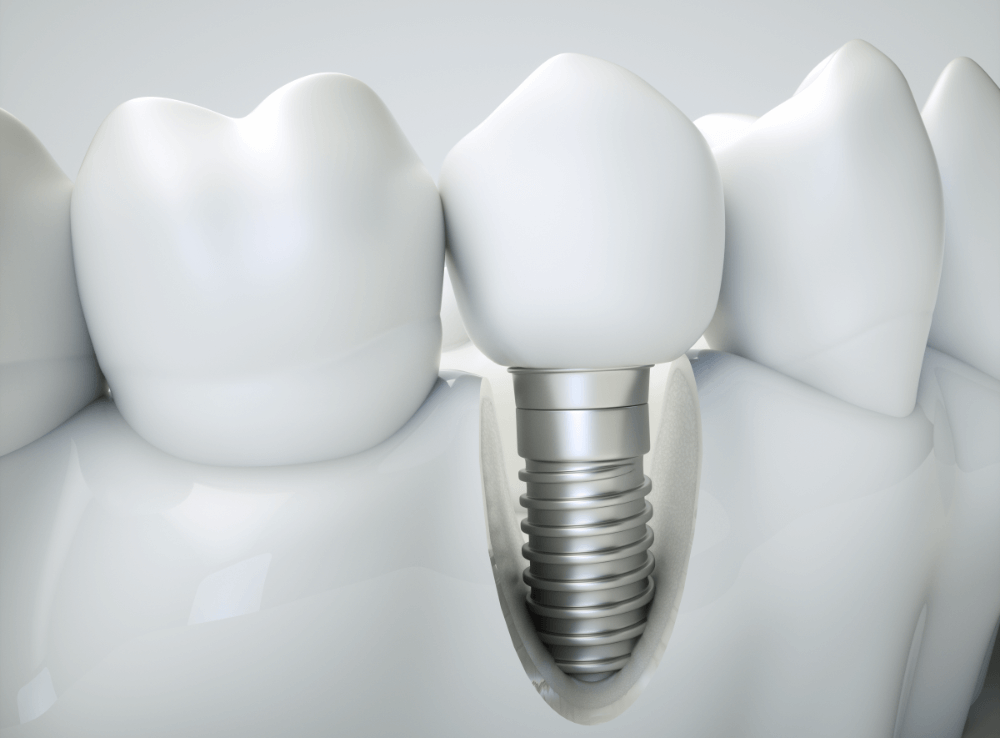Tips To Prevent Dental Implants Infection