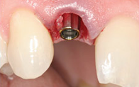 Dental Implants Price