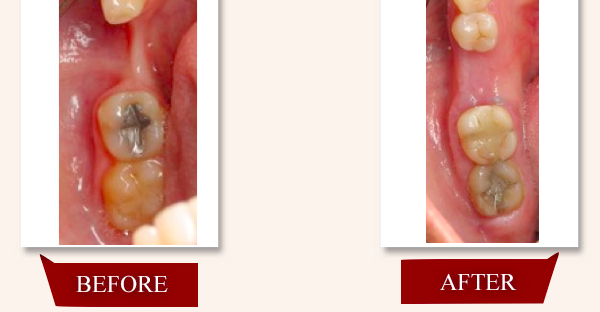 bone grafting before and after