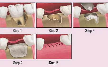 Bone grafting steps
