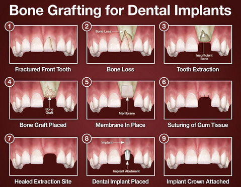 bone grafting