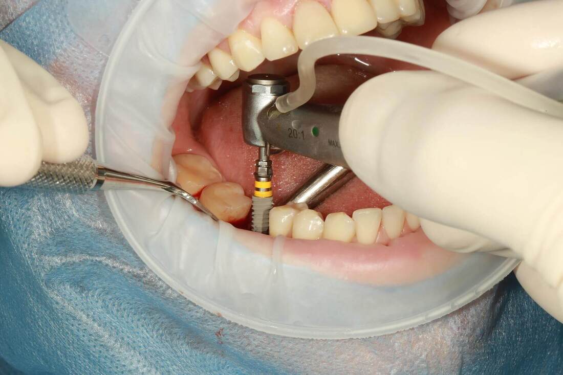 dental implants in Melbourne