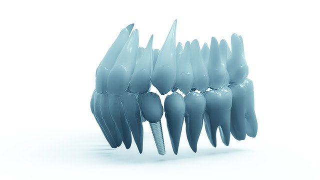 Insights on Dental Implants Cost in Melbourne 