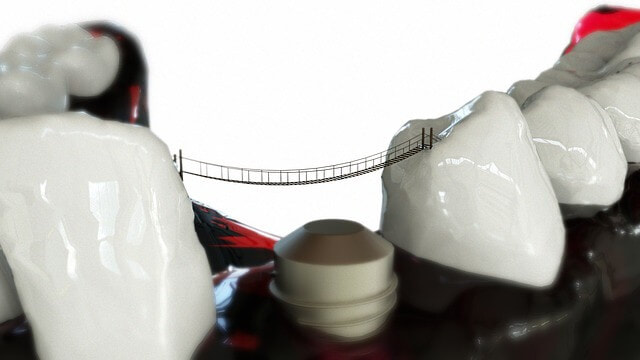 Dental Implant 101; Part and Pieces 