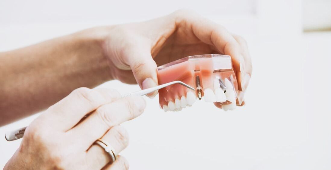 Key Factors That Influence the Cost of Dental Implants