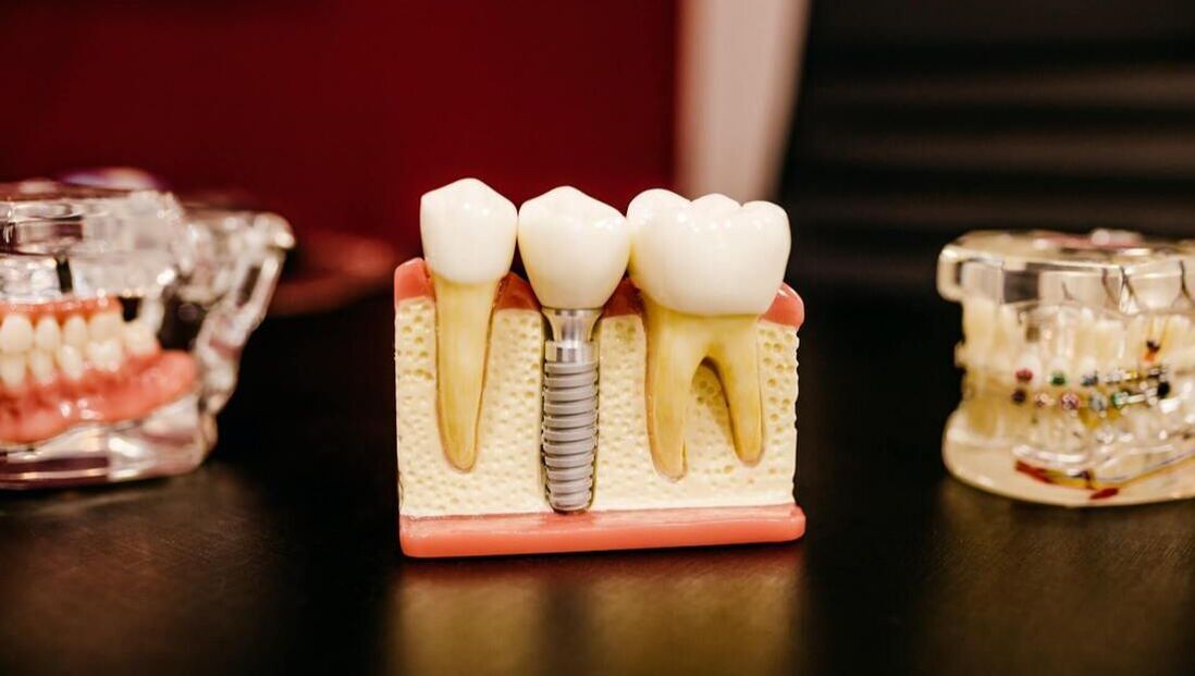 Tips for Recovering Quickly From Dental Implants Surgery