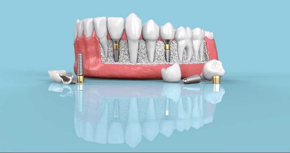 How Long Do Dental Implants Last?