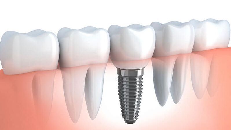 What are the Common Misconceptions to Avoid with All-on-4 Dental Implants?Picture