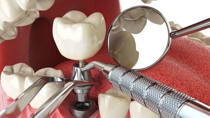 Can Dental Implants Make Your Life Better?