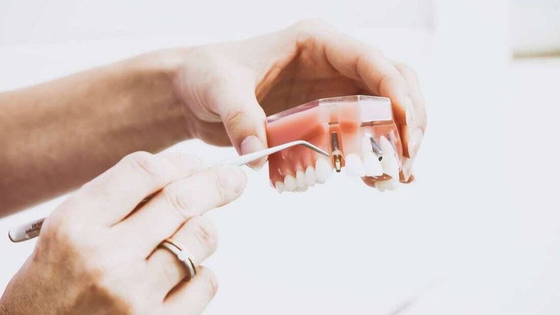 How Much Do Dental Implants Cost?
